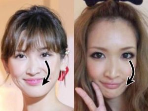 紗栄子の鼻が変 矢印で曲がってる 昔と顔が違うのは整形 変化画像 Informed House